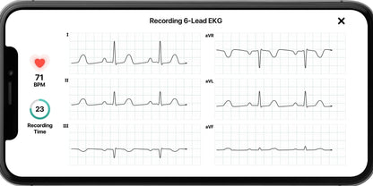 AliveCor KardiaMobile 6L Personal EKG Monitor, Black - KM-6L-E